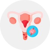 Ovarian Cysts